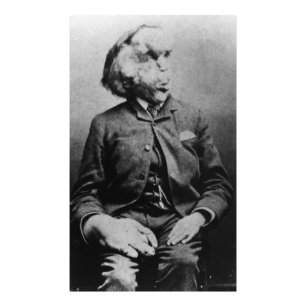 Joseph "John" Merrick Elephant Man ab 1889 Fotodruck