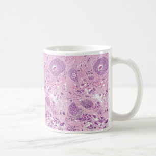 Kaffee Tasse-Brust Krebs-Zellen Kaffeetasse