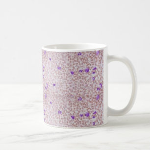 Kaffee-Tasse - chronische Myeloid Leukämie (CML) Kaffeetasse