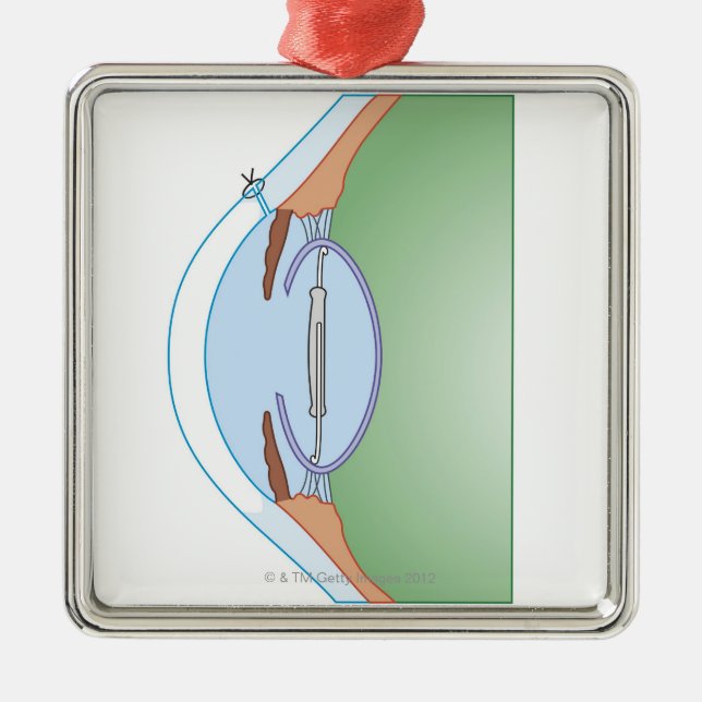 Katarakt-Operation Ornament Aus Metall (Vorne)