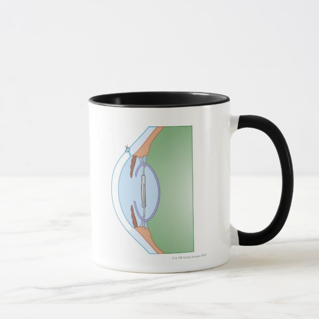 Katarakt-Operation Tasse (Rechts)