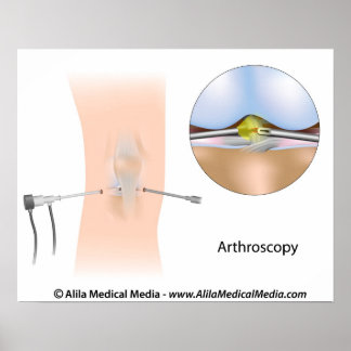 Kniearthroskopie-Diagramm Poster