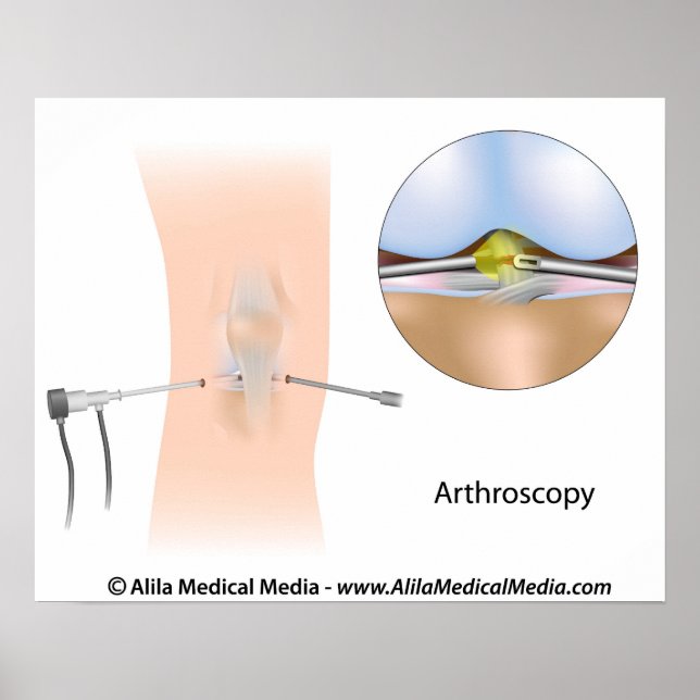 Kniearthroskopie-Diagramm Poster (Vorne)
