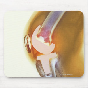 Kniegelenksersatz. Farbige Röntgenaufnahme eines g Mousepad