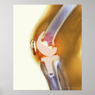 Kniegelenksersatz. Farbige Röntgenaufnahme eines g Poster