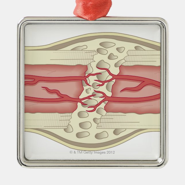Knochen, der 2 sich repariert ornament aus metall (Vorne)