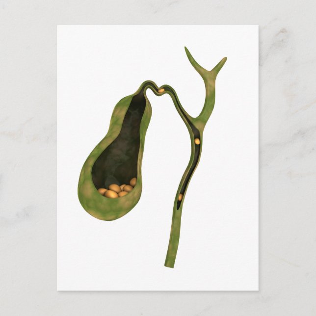 Konzeptbild von Gallstones im Gall Postkarte (Vorderseite)