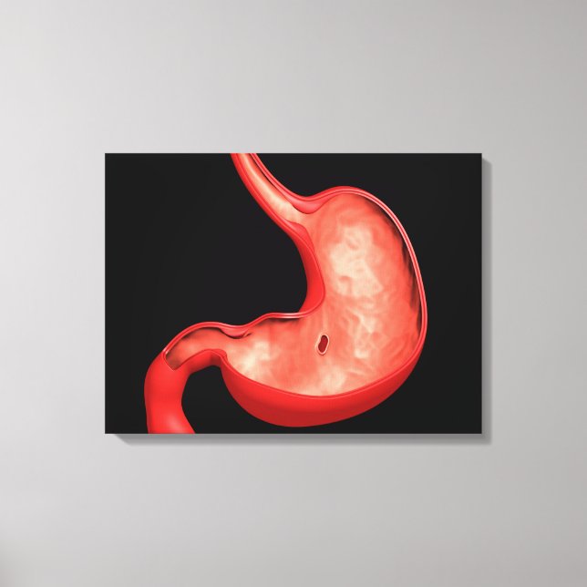 Konzeptuelles Bild eines peptischen Ulkus im Magen Leinwanddruck (Vorderseite)