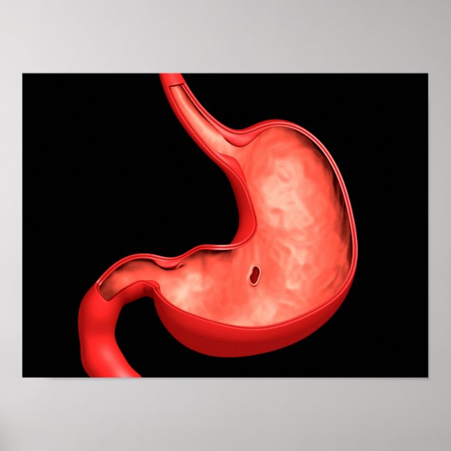 Konzeptuelles Bild eines peptischen Ulkus im Magen Poster (Vorne)
