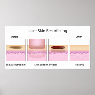 Laserhaut-Wiederbelebungsverfahren Poster