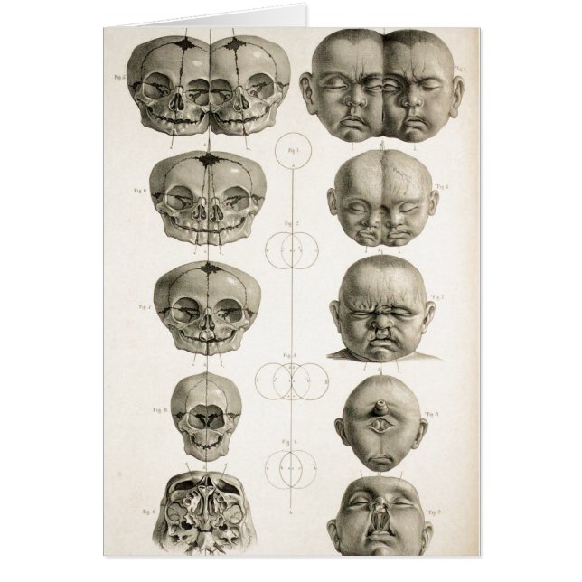 Les défauts de forme infantiles de crâne (Devant)