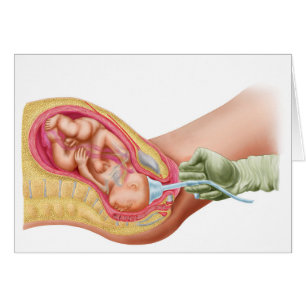 Livraison Du Foetus À L'Aide De L'Extraction Vacue