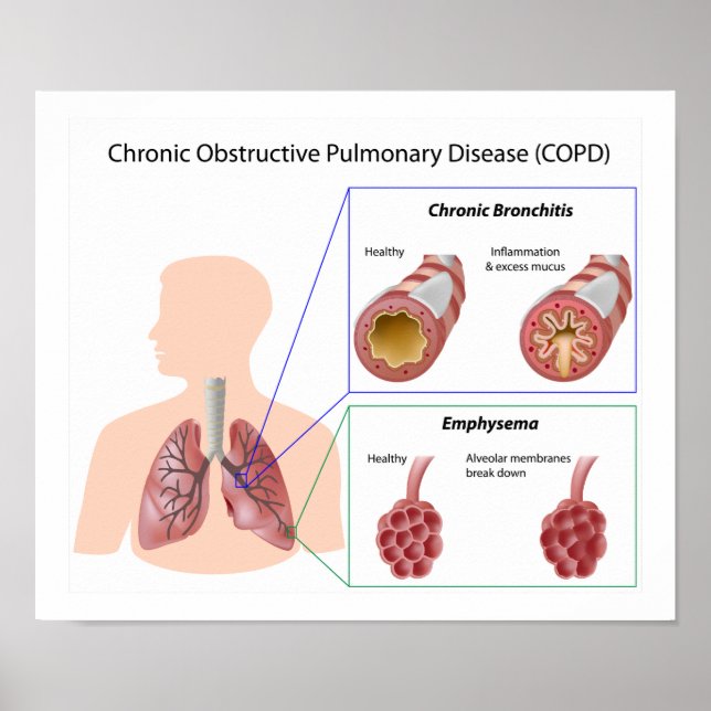 Lungenerkrankung (COPD) Poster (Vorne)