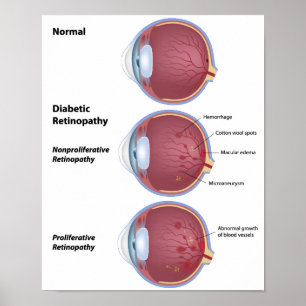 Maladie des yeux Rétinopathie diabétique Poster