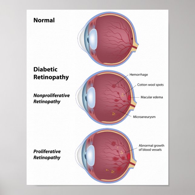Maladie des yeux Rétinopathie diabétique Poster (Devant)
