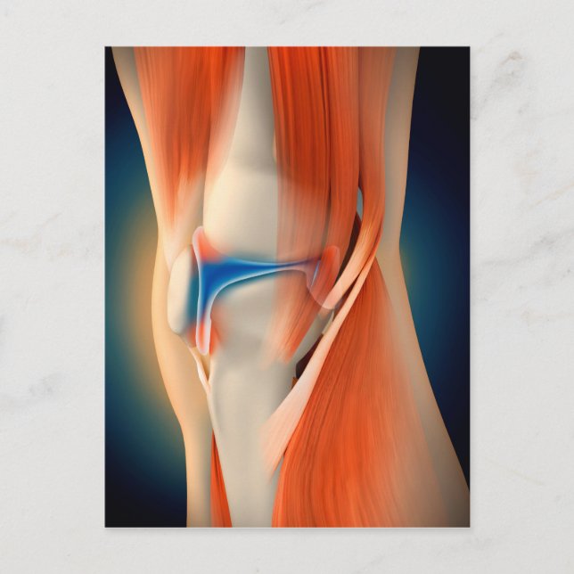 Medical Illustration: Inflammation In Knee Postkarte (Vorderseite)
