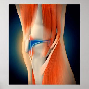 Medizinische Illustration: Entzündung im Knie Poster