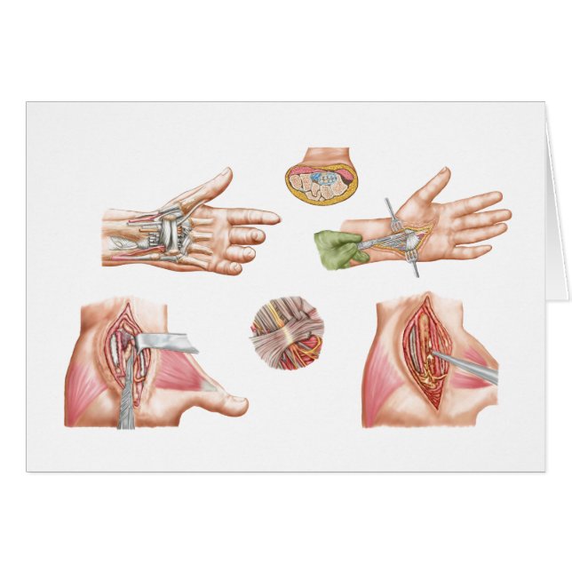 Medizinische Illustration mit Carpal Tunnel (Vorderseite (Horizontal))