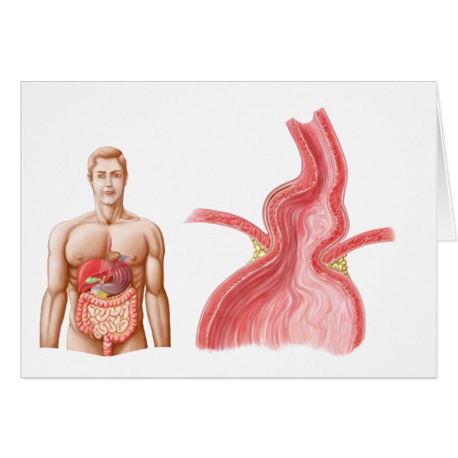 Medizinische Ilustration einer Hiatalhernie in der (Vorderseite (Horizontal))