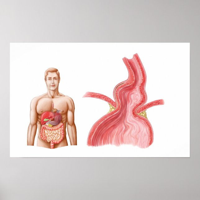 Medizinische Ilustration einer Hiatalhernie in der Poster (Vorne)
