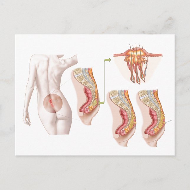 Medizinische Ilustration einer Pilonidalzyste Postkarte (Vorderseite)