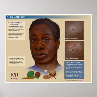 Melalogic Akne and Diet Medical Poster