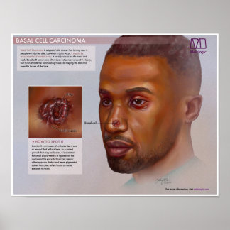 Melalogic Basalzellkarzinom Medikales Poster