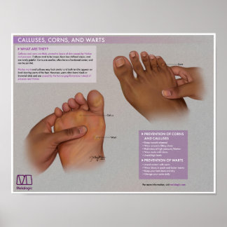 Melalogic Calluses, Corns and Warts Medical Poster