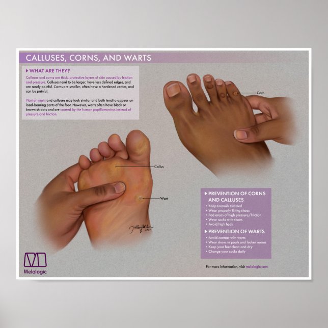 Melalogic Calluses, Corns and Warts Medical Poster (Vorne)