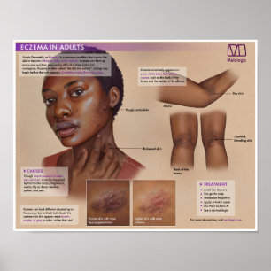 Melalogic Eczema Medical Poster