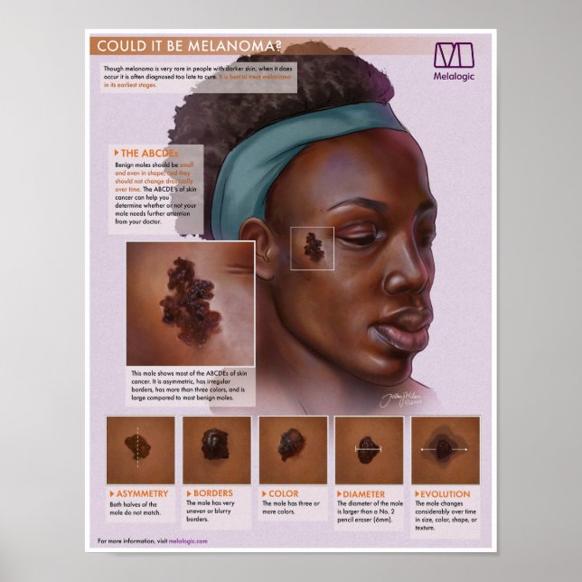 Melalogic Melanoma Medical Poster (Vorne)