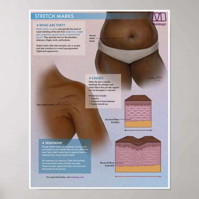 Melalogic Stretch Markus Medical Poster (Vorne)