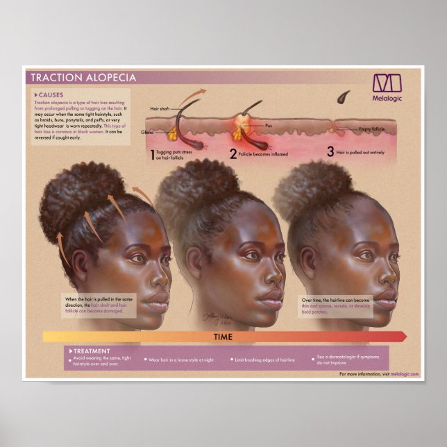 Melalogic Traction Alopecia Poster Médicale (Devant)