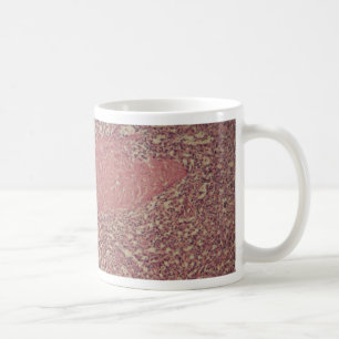 Menschliche Milz mit chronischer myelogenous Kaffeetasse