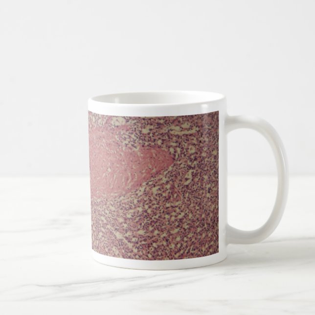 Menschliche Milz mit chronischer myelogenous Kaffeetasse (Rechts)