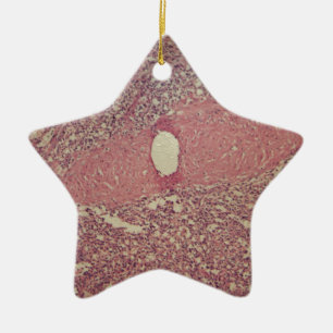 Menschliche Milz mit chronischer myelogenous Keramikornament