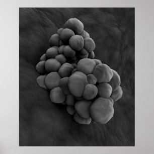 Mikroskopische Ansicht von Tumor 1 Poster