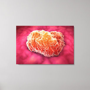 Mikroskopische Ansicht von Tumor 3 Leinwanddruck