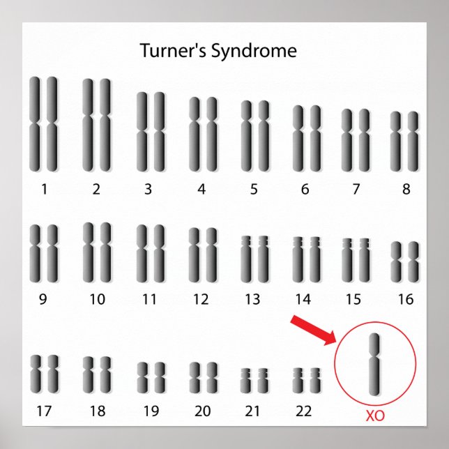 Monosomy X, Turner-Syndrom Poster (Vorne)