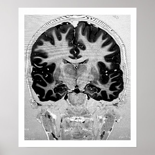MRI Head Poster (Vorne)
