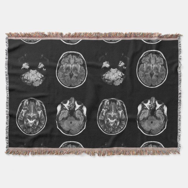 MRT des Gehirns Decke (Vorderseite)