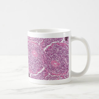 Mug Cellules cancéreuses de Tasse-Poumon de Coffe