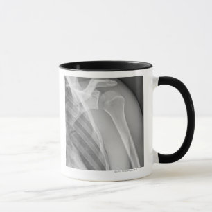 Mug Épaule normale. Rayon X de la gauche saine