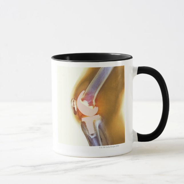 Mug Remplacement de genou. Rayon X coloré d'un genou (Droite)