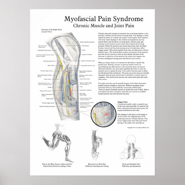 Myofasziales Schmerzsyndrom Poster (Vorne)