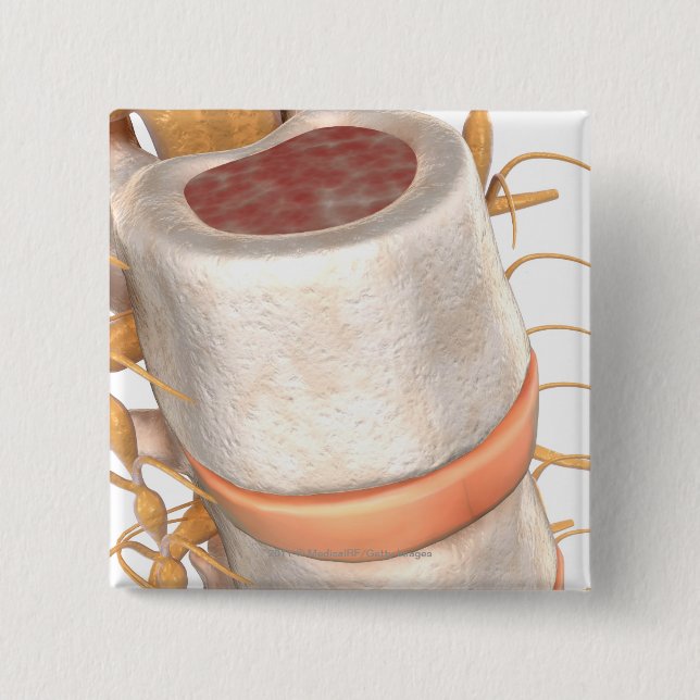 Nah oben von einem invertebral Disc im Dorn Button (Vorderseite)