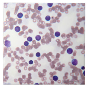 Neoplastische Lymphozyte-Zellen Fliese