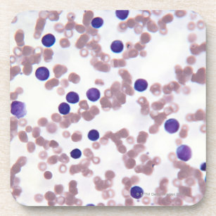 Neoplastische Lymphozyte-Zellen Getränkeuntersetzer