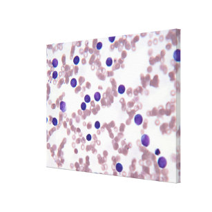 Neoplastische Lymphozyte-Zellen Leinwanddruck