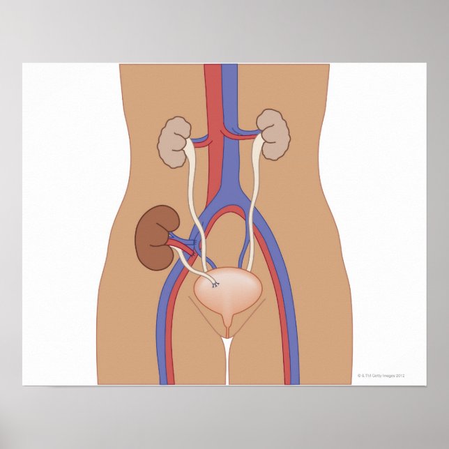 Nierentransplantation Poster (Vorne)